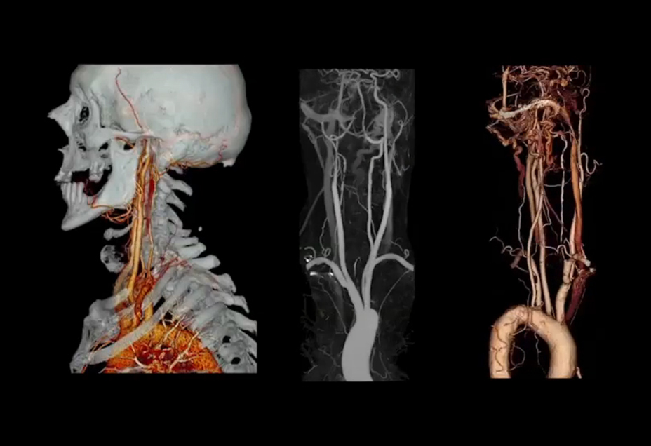 ct-aq-one-adaptive-diag-sure-subtraction.jpg