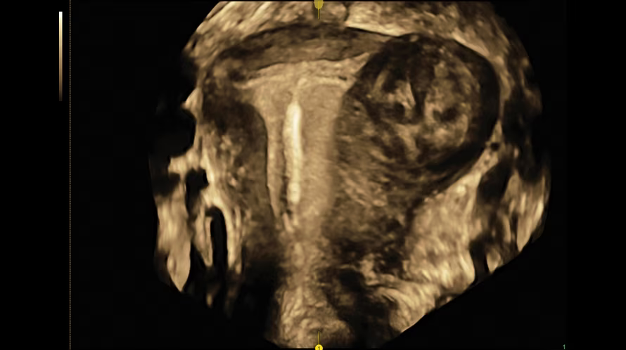 gallery_0007_iud-and-fibroid-with-omniview.png