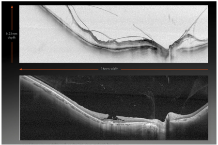 Optovue SOLIX