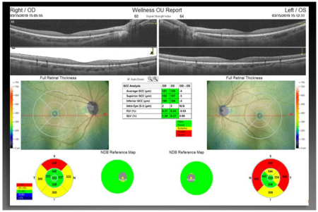 Optovue SOLIX
