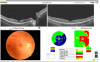 Optovue SOLIX