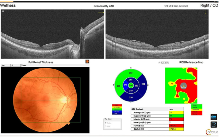 Optovue SOLIX