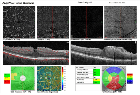 Optovue SOLIX