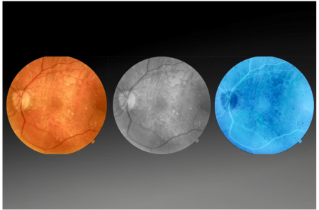 Optovue SOLIX